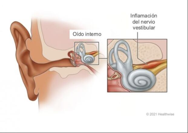 La neuritis vestibular es una inflamación del nervio vestibular, el cual se encarga de transmitir información crucial sobre el equilibrio desde el oído interno al cerebro. Esta inflamación provoca que las señales sobre la orientación espacial y el equilibrio se vean alteradas, lo que lleva a síntomas incapacitantes como vértigo intenso, náuseas, vómitos y dificultades para mantener el equilibrio, afectando significativamente el rendimiento de cualquier atleta de alto nivel. (Foto: Healthwise)