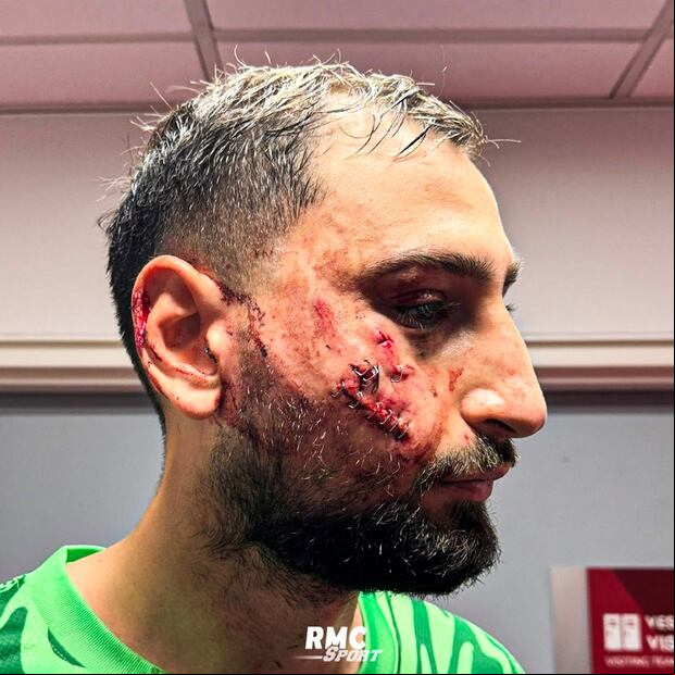 Así quedó el rostro de Gianluigi Donnarumma. (Foto: Arthur Perrot).